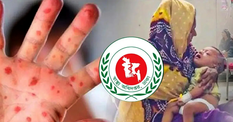হাম ও হামের উপসর্গে আরও ৪ শিশুর মৃত্যু, মোট ৬৫২